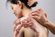 Psoriasis