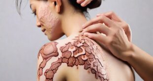 Psoriasis