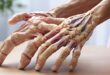 Rheumatoid arthritis