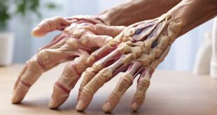 Rheumatoid arthritis